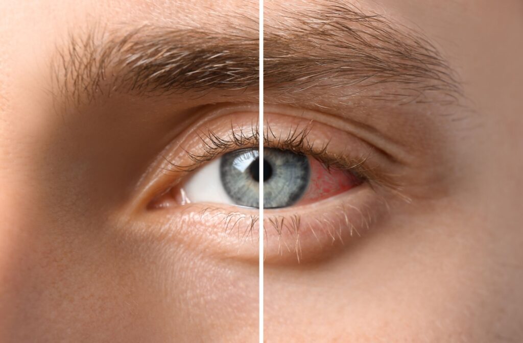 Up close image of an eye showing one half normal and one half inflamed.