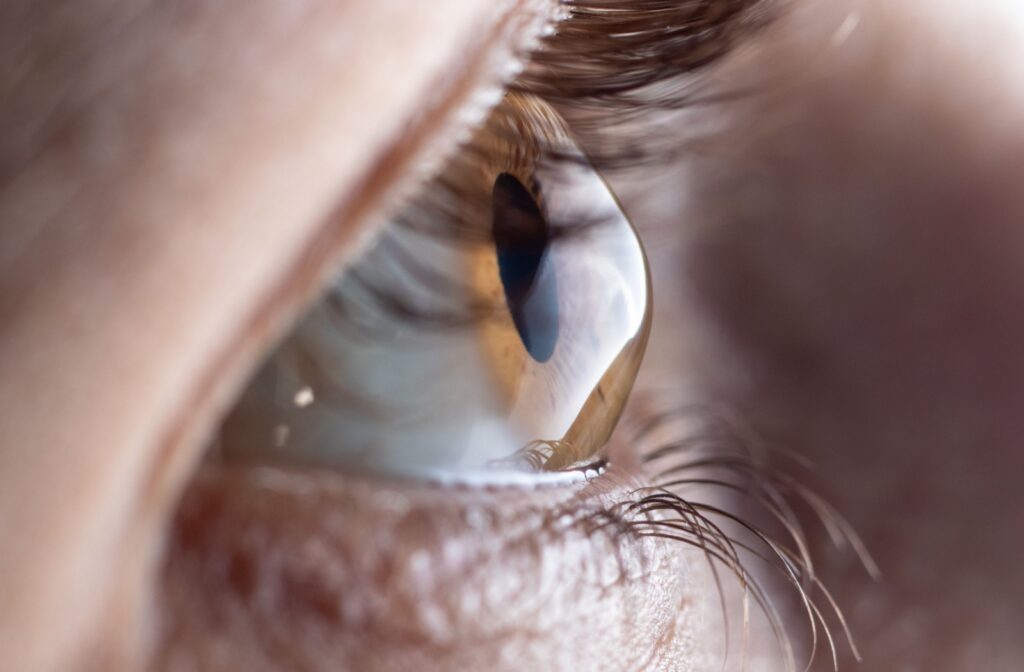 Close-up image of an eye with keratoconus showing a cone-shaped cornea, illustrating symptoms of eye diseases detectable in a comprehensive eye exam.