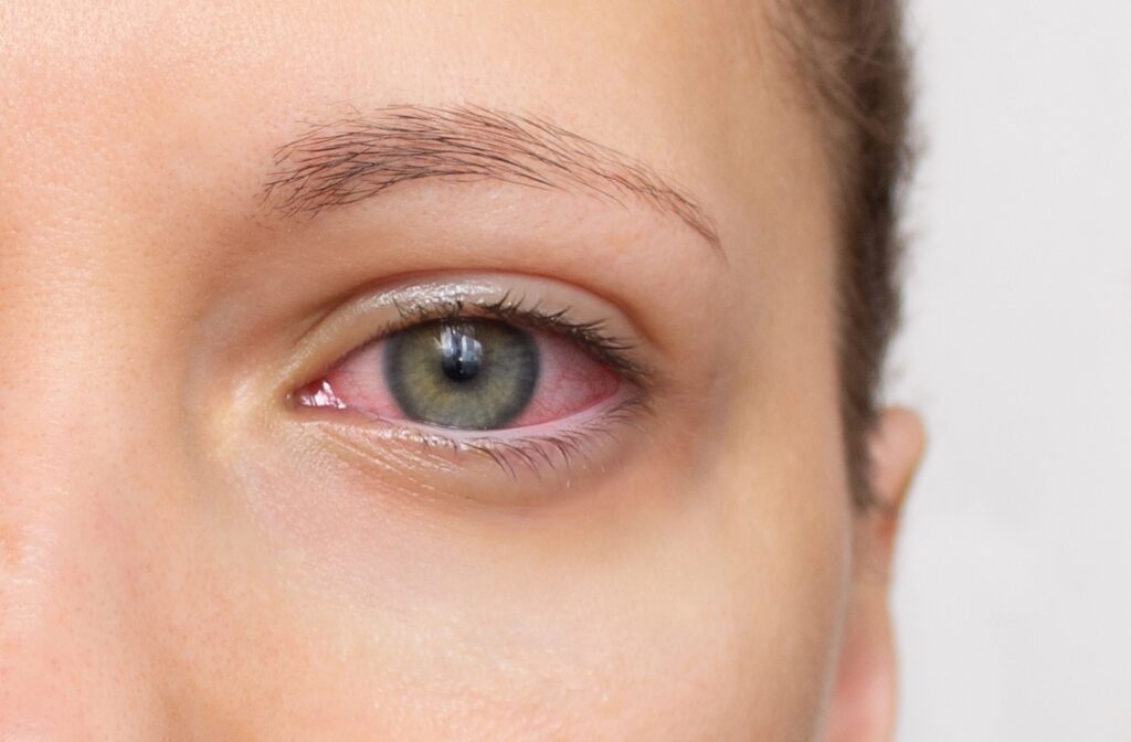 Close-up of an irritated, red eye showing a common symptom of dry eye disease (DED).