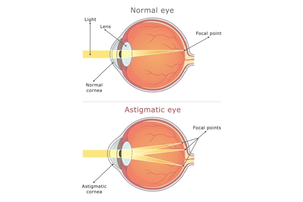 Illustration of a normal eye and an astigmatic eye demonstrating differences in corneal shape and how incoming light focuses inside the eye.
