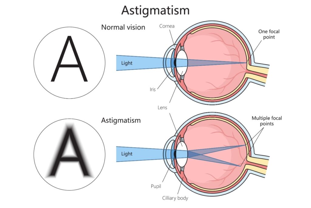 Diagram comparing normal vision and astigmatism, showing how an irregular cornea creates multiple focal points and causes blurred vision.